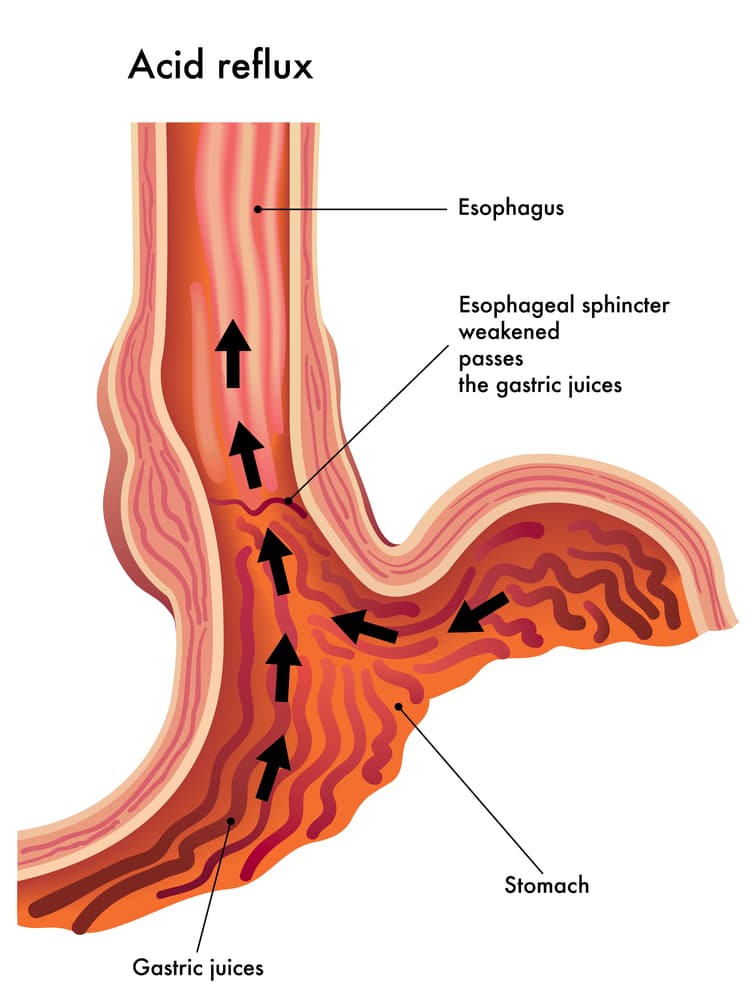 acid reflux