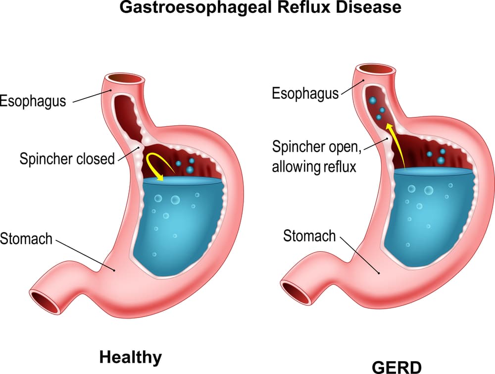 what is acid reflux